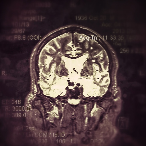 Brain Scan FTD Dementia